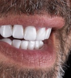 שתלים וחיים חדשים: כך התגבר מטופל בן 55 על הפחד מרופאי שיניים-תמונה